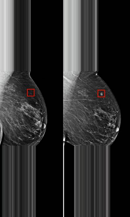 The image on the left shows something the AI identified as cancer, on the right is four years later as it started to develop. Credit: Lauder Breast Center at the Memorial Sloan Kettering Cancer Center/CNN
